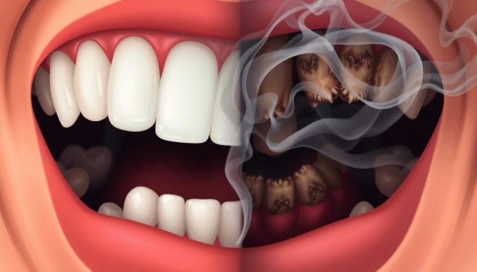 Smoking and Oral Health